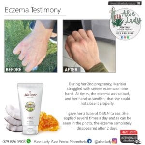 X-Balm Testimony - Eczema Relief in 2 Days