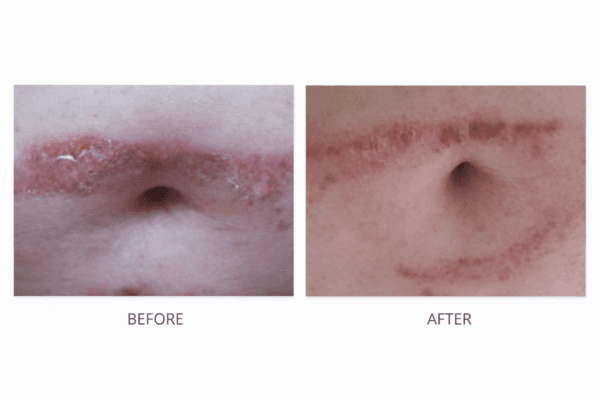 Super Aloe Gel – Burn Healing Testimonial