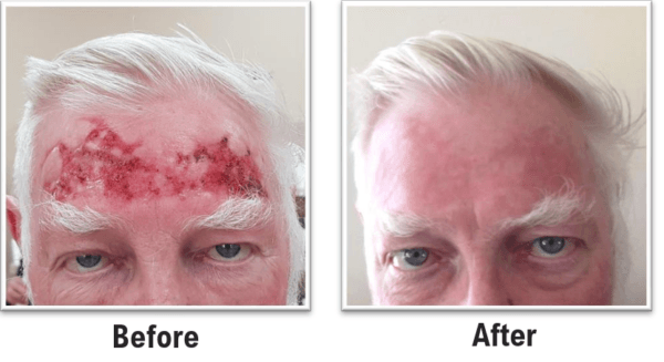 When Nothing Worked… Until Bitter Aloe Gel